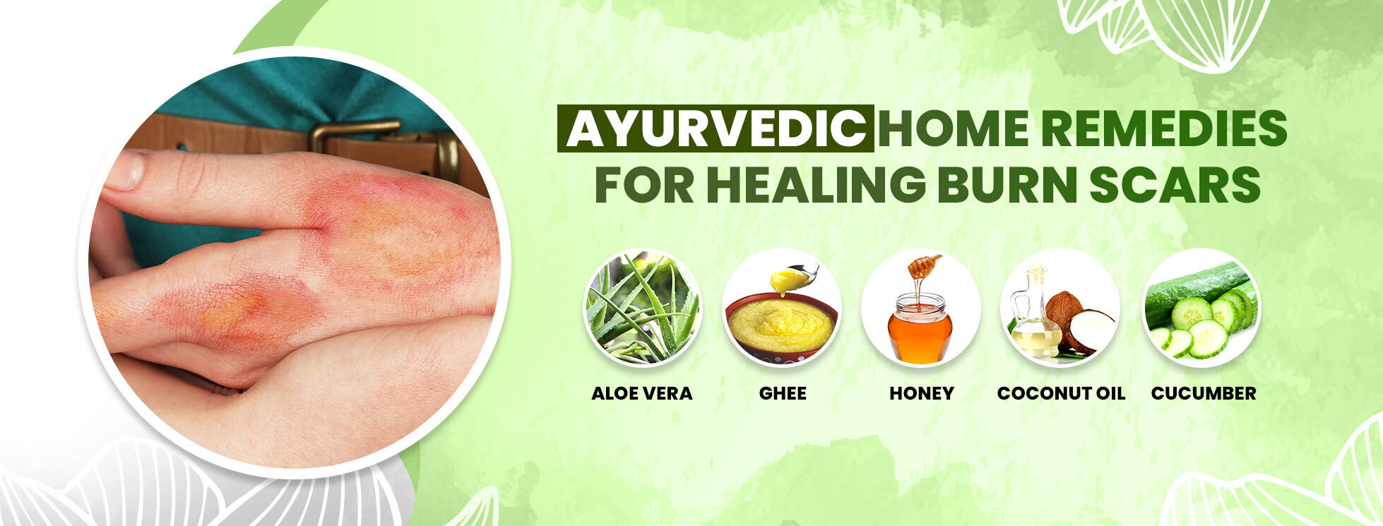 10 Ayurvedic Home Remedies for Healing Burn Scars: A Comprehensive Guide